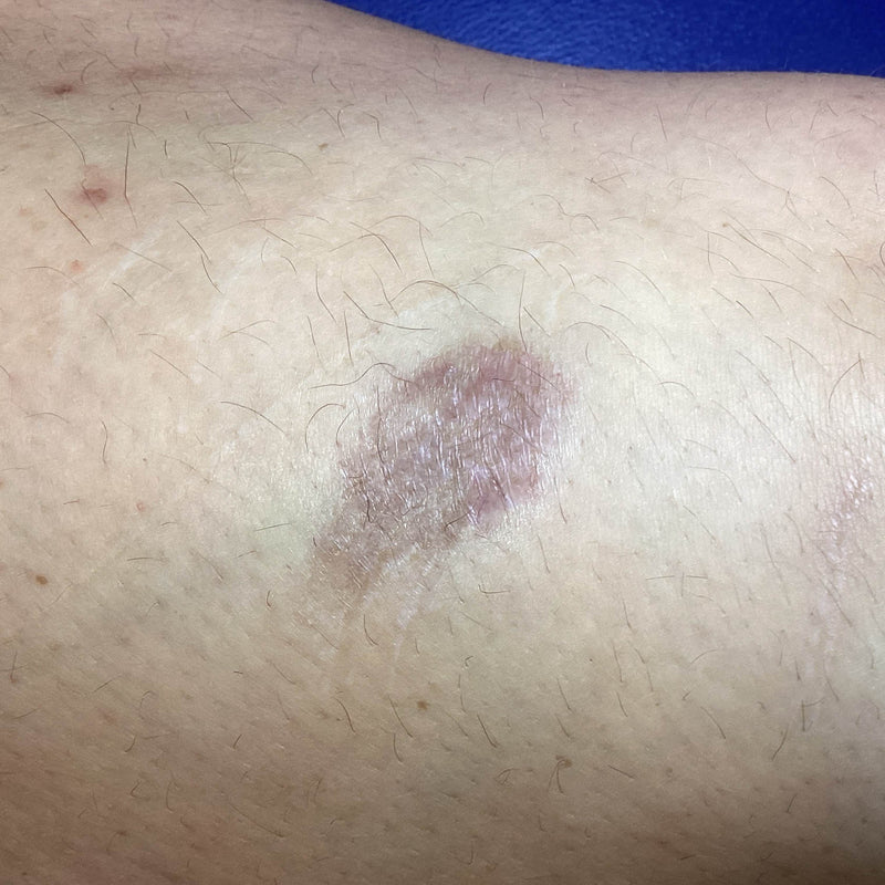 Before treatment