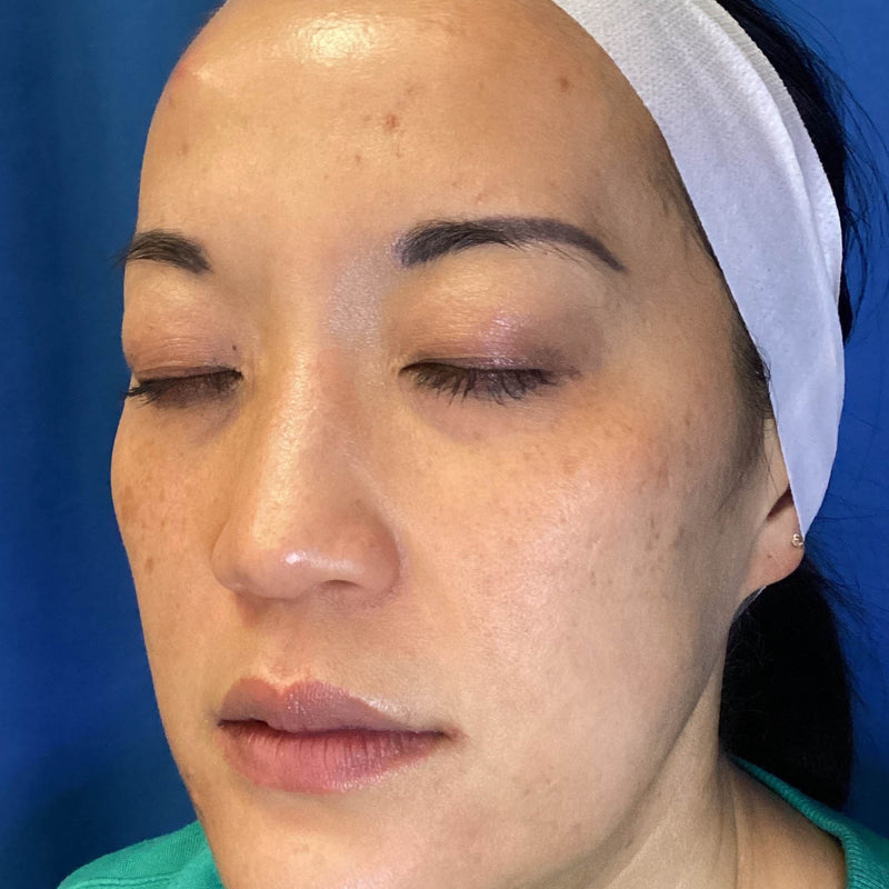 After treatment