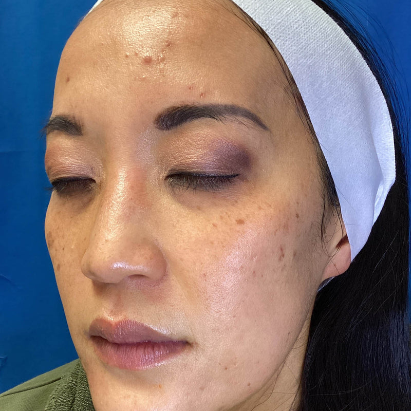 Before treatment
