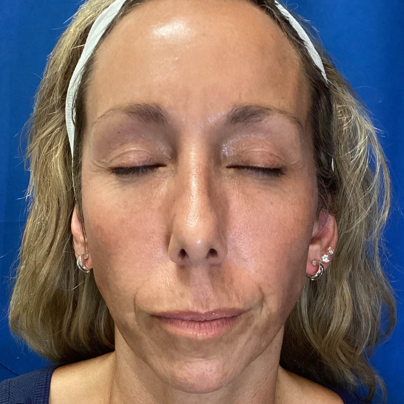 After treatment