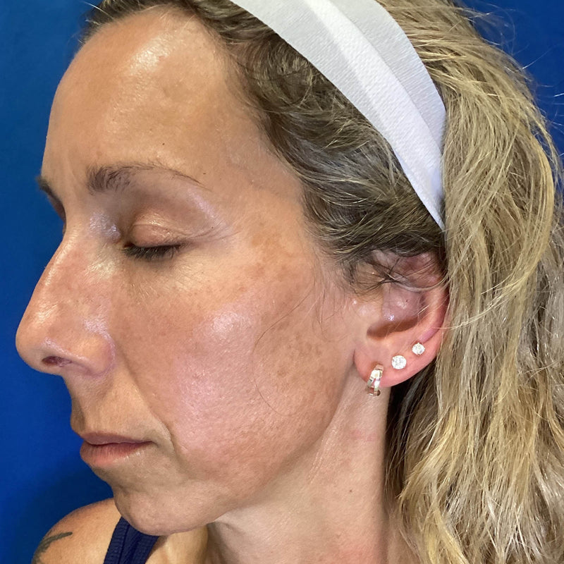 After treatment