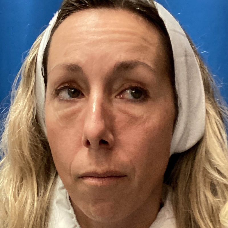 Before treatment