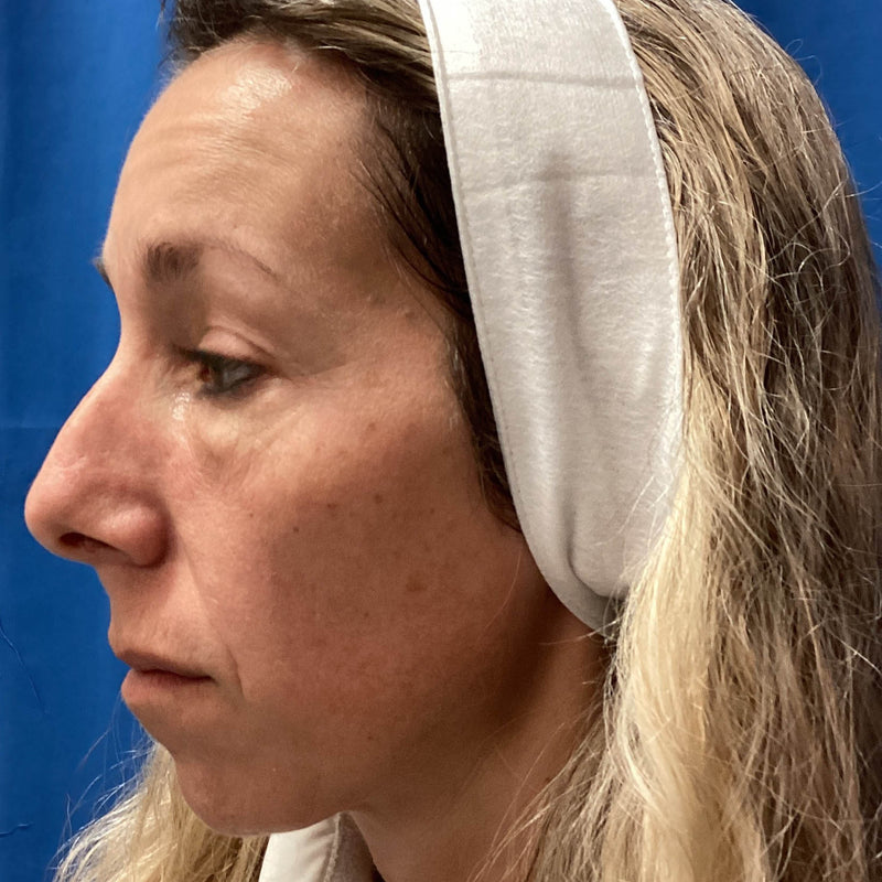 Before treatment