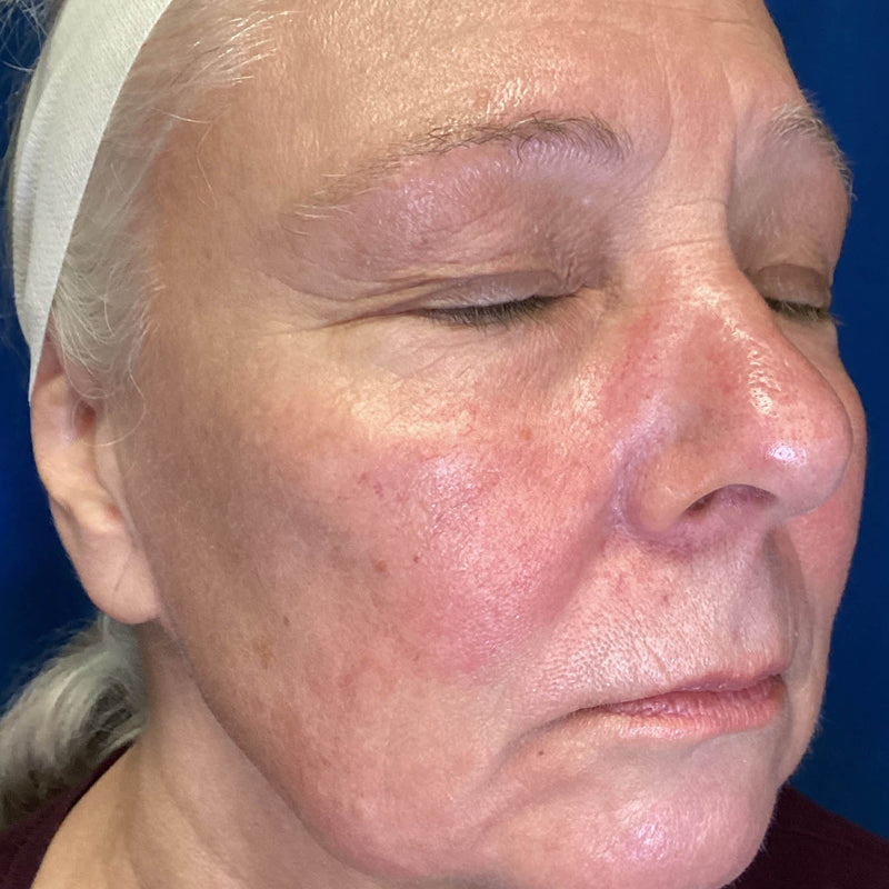 Before treatment
