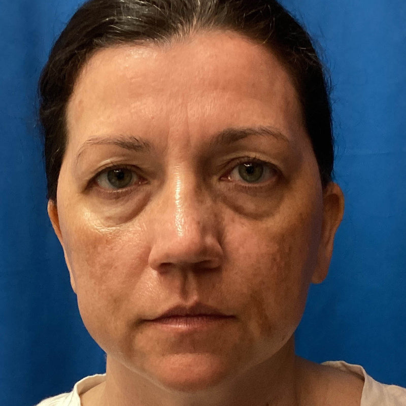 Before treatment