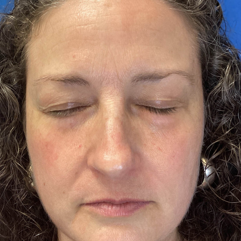 After treatment