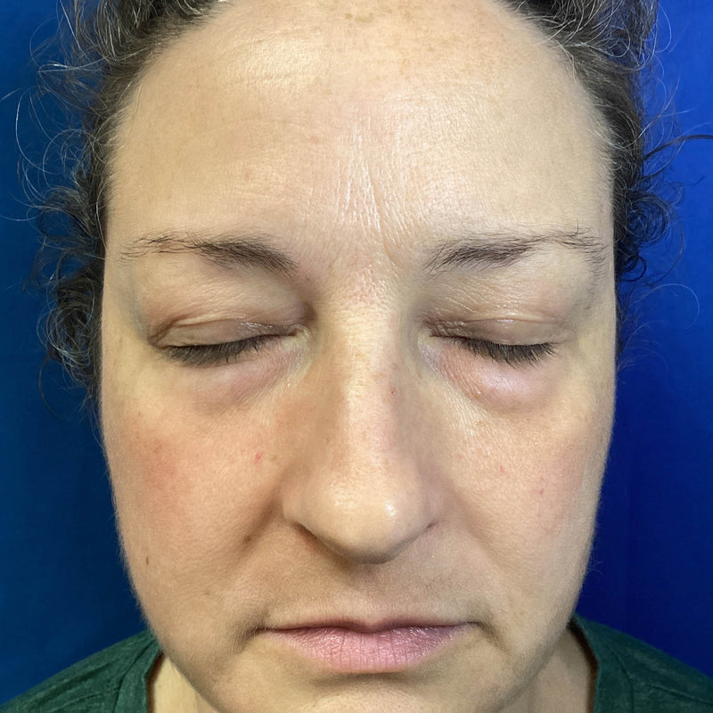 Before treatment