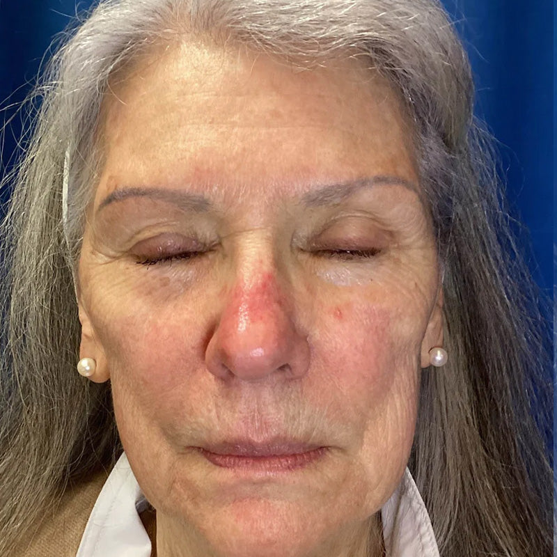 Before treatment