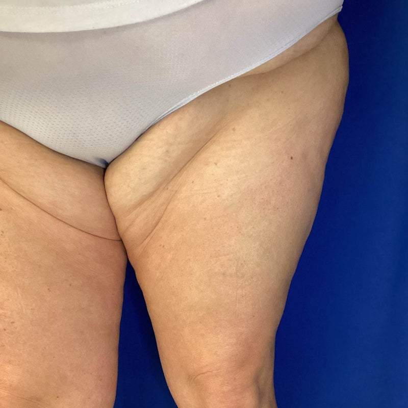 Before treatment
