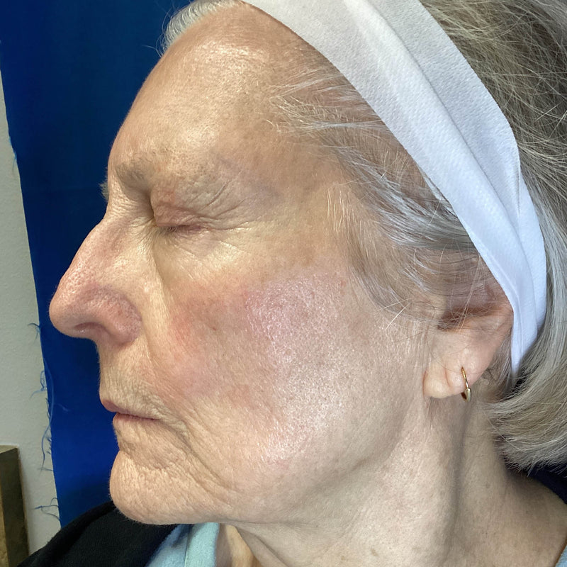 After treatment