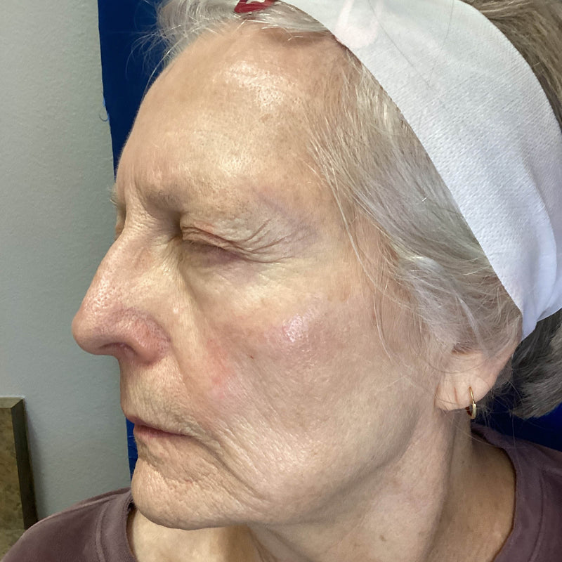 Before treatment