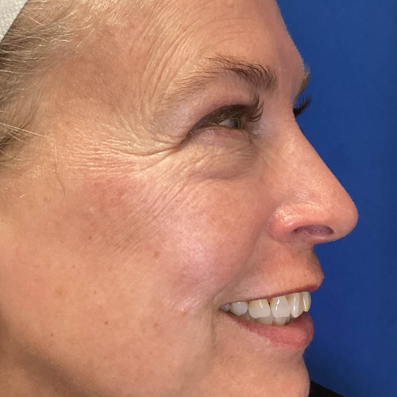 After treatment