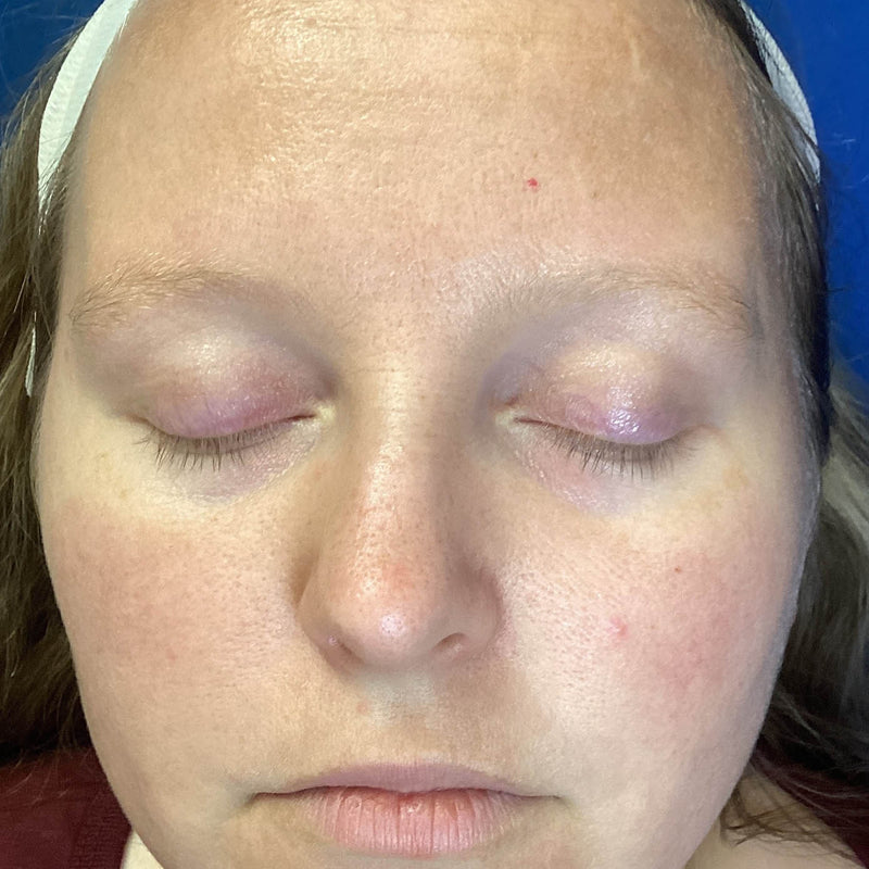 Before treatment