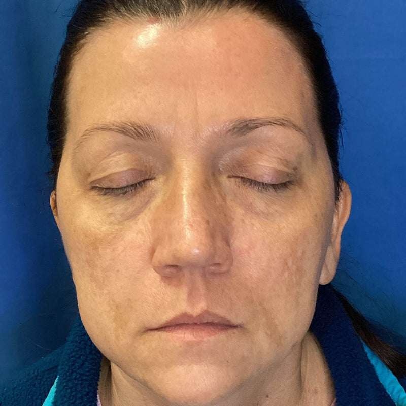 After treatment